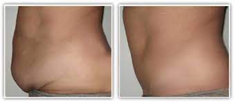L'abdominoplastie est l'intervention de chirurgie plastique la plus fréquemment pratiquée, juste après la réduction mammaire. L Abdominoplastie Indications Techniques Remboursement Suites Et Cout Doctissimo