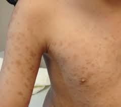 Image result for Urticaria pigmentosa children