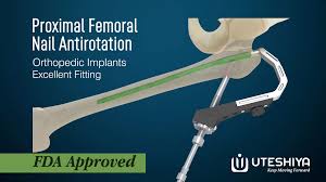 PFNA: Advancing Femoral Fracture Treatment with Proximal ...