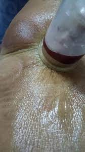 Maybe you would like to learn more about one of these? Bengkak Buku Lali Bukan Gout Bekam Bekam Z Kota Masai Facebook