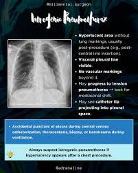 Image result for Pneumothorax