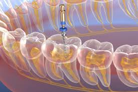 3 Signs You Should Seek Endodontic Treatment - Prince William Dental  Gainesville Virginia