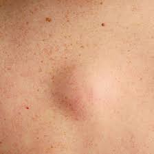 The medical word for this type of acne blemish is a papule. 13 Face Bumps You Get Under Your Skin And How To Get Rid Of Them