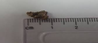 A Dark Gray Stag Horn Kidney Stone Download Scientific Diagram