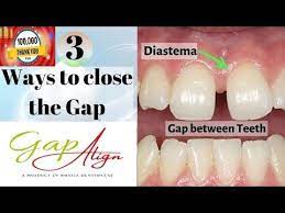 Unfortunately, many options for fixing gap teeth are invasive and extremely expensive. Gap In Front Teeth Diastema Closure How To Fix Teeth Gap Without Braces Gapalign Dr Srishti Youtube