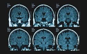 Arizona had highest self-reporting of confusion, memory loss in survey of 18  states