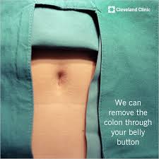 A Colon Removed Through The Belly Button Check Out The Benefits Of This Minimally Invasive Surgery Abdominal Exercises Post Surgery Abs Workout