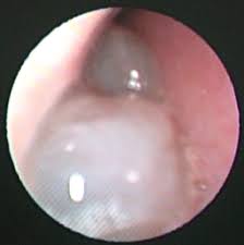 In anatomy, a polyp is an abnormal growth of tissue projecting from a mucous membrane. Antrochoanal Polyp A Literature Update