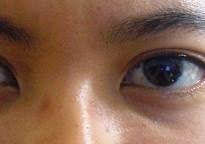 Bye bye nose dents mission is to find a way for all those who suffer from nose dents to make their glasses comfortable. Dark Mark On Nose Glasses Skin Marks Remove Dark Spots Nose