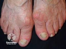 Image result for Pitting nails feet