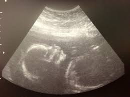 20 Week Scan Babies Head Small Babycentre