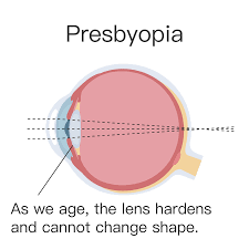 Image result for Presbyopia