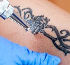 No other tattoo removal company has performed over 250,000+ successful sessions focused entirely on tattoo removal. Tattoo Removal Centre Tattoo Removal Tattoo Removal Prices Laser Tattoo Removal Price