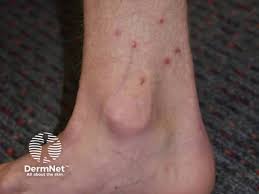 Image result for flea bite