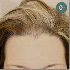 Polycystic ovary syndrome (pcos) is another possible causes of hair thinning for women. Hair Transplant Patient Of Dr Jean Devroye On Femaleclass Na 2205 Grafts
