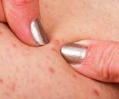 Image result for Deep Folliculitis