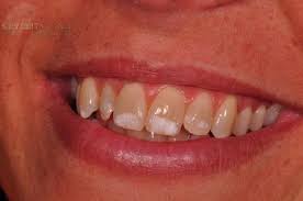Baking soda will subtly give you the abrasion that is needed by your teeth to remove white spots along with balancing the ph levels of your mouth. White Spots How To Remove Them Styleitaliano Org