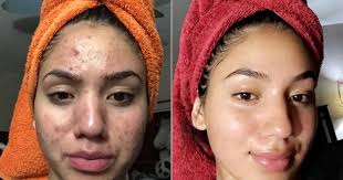 Untuk menghilangkannya kalian cukup dengan membuat sebuah masker dari lemon, kalian penasaran caranya? Cara Menghilangkan Bekas Jerawat Dengan Cepat Dalam 1 Hari Terbukti Ampuh