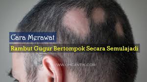 Cara mengatasi rambut rontok yang terakhir, yaitu menggunakan lemon. Cara Merawat Botak Bertompok Alopecia Areata Secara Semulajadi Ohcantik Com