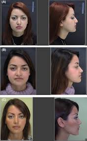 Orthognathic surgery to treat jaw discrepancy and malocclusion may be viewed variably by insurance carriers. Orthognathic Surgery Again To Correct Aesthetic Failure Of Primary Surgery Report On Outcomes And Patient Satisfaction In 70 Consecutive Cases Sciencedirect