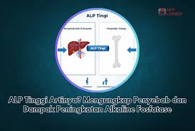 ALP Tinggi Artinya? Mengungkap Penyebab dan Dampak Peningkatan Alkaline  Fosfatase