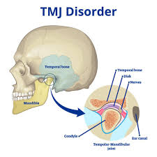 Image result for Jaw Claudication