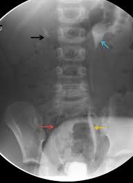 Is your child due for a vcug? Vesicoureteral Reflux Article