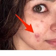 We did not find results for: Ù…Ø§ Ø£Ù†ÙˆØ§Ø¹ Ø­Ø¨ÙˆØ¨ Ø§Ù„ÙˆØ¬Ù‡ Ùˆ Ø¹Ù„Ø§Ø¬Ø§ØªÙ‡Ø§ Ù…Ø±Ú©Ø² Ø¨ØµÛŒØ± Ù„Ø·Ø¨ Ø§Ù„Ø¹ÛŒÙˆÙ†