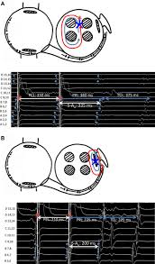 Atrial overdrive pacing during tachycardia can rapidly differentiate jt from avnrt, which can improve the safety and efficiency of catheter ablation of these arrhythmias. Overdrive Pacing From Downstream Sites On Multielectrode Catheters To Rapidly Detect Fusion And To Diagnose Macroreentrant Atrial Arrhythmias Circulation