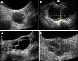 Unfortunately, only about 20 percent of. Gynecologic And Reproductive Outcomes In Fibrous Dysplasia Mccune Albright Syndrome Orphanet Journal Of Rare Diseases Full Text