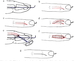 Surgical repair of the mallet finger may be considered in some cases. Figure 1 From A New Surgical Treatment For Mallet Finger Deformity Deepithelialised Pedicled Skin Flap Technique Semantic Scholar
