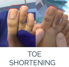 Day in my life (toe surgery & lipo). For Some Reason Makemesuffer