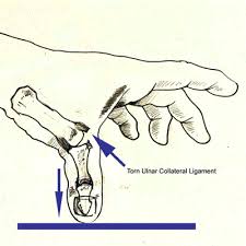 Thumb collateral ligament injuries include radial collateral ligament rare. Skier S Thumb The British Society For Surgery Of The Hand