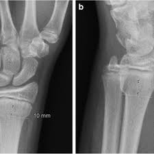 Check spelling or type a new query. Pdf Differentiating Stable Buckle Fractures From Other Distal Radius Fractures The 1 Cm Rule