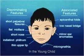 The epicanthal fold is the skin fold of the upper eyelid covering the inner corner of the eye, most often seen in mongoloid people. Epicanthal Folds Fas