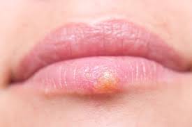 Herpes 1 once is enough. Natural Herpes Hsv1 Hsv2 Natural Treatment Lifeworks