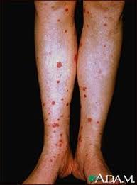 Depending on their size, purpuric lesions are traditionally classified as petechiae (pinpoint hemorrhages less than 2 mm in greatest diameter), purpura (2 mm to 1 cm) or ecchymoses (more than 1 cm. Pin On Nursing V