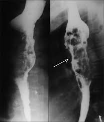 Epidemiology the actual incidence and prevalence of idiopathic esophagitis of hiv are unknown. Barium Esophagogram In Various Esophageal Diseases A Pictorial Essay Abstract Europe Pmc