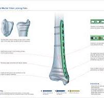 Distal Medial Tibial Locking Plate,Medical Device ...