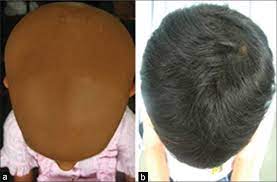 The efficacy of anthralin may be limit … Extensive Alopecia Areata Not Necessarily Recalcitrant To Therapy