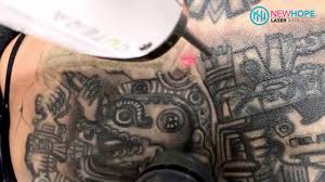 With hundreds of successful treatments and happy clients, we are happy to help you remove your tattoos or cover up some ink to make room for more art. Laser Tattoo Removal Removing Aztec Tattoo Off Back Newhope Laser Skin Care Orange County Youtube