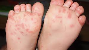 Uncommon before the first what it looks like: Foot Rash Causes Symptoms And Treatments