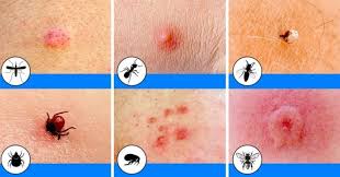 Spider Bites That Look Like Mosquito Bites 10 Bug Bites Anyone Should Be Able To Identify Http Machine Toptrendspint Jumpsuitoutfitdressy Tk Bites And Stings Bug Bites Bed Bug Bites