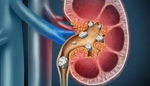 Can Monster Energy Drinks Cause Kidney Stones