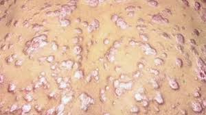 Because it was spread by returning french troops, the disease was known as french disease, and it was not until 1530 that the term syphilis was first applied by the italian physician and poet girolamo fracastoro. Syfilis Zdravoteka