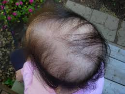 Hair loss is called alopecia. Chemotherapy Hair Loss It Is A Big Deal Nancy S Point