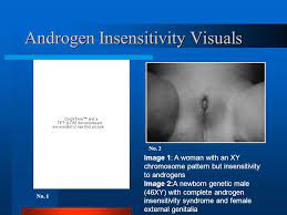 Automatic identification systems (ais) transponders are designed to be capable of providing position, identification and other information about the ship to other ships and to coastal authorities. Androgen Insensitivity Syndrome Ais Ppt Video Online Download