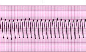 Cardiac Rhythm Strips Cardiac Rhythms Ekg Rhythms Cardiac