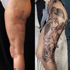 I am 32 and i received a tattoo when i was 22. Scarring Form David Allen