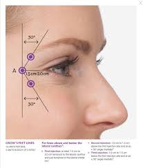 Crow S Feet 1 Crowsfeetproducts Botox Injection Sites Facial Aesthetics Botox